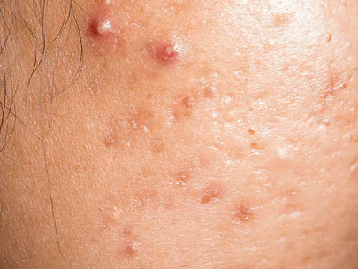 Acne Control